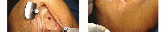 Illustration 16 for Unicondylar Knee Arthroplasty: Is This Your Solution to Knee Pain?