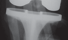 Mastering Periprosthetic Femoral Fractures Above Knee Arthroplasty