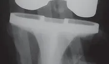 صورة توضيحية لـ كسور الفخذ حول المفصل الصناعي للركبة: دليل الأستاذ الدكتور محمد هطيف للتعافي الآمن