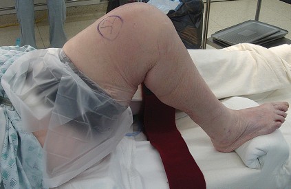 Illustration 18 for Mastering TKA: Essential Methods of Rotational Alignment