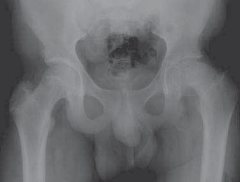 Realignment for Severe Slipped Capital Femoral Epiphysis Deformity