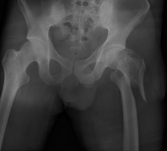 Unstable Intertrochanteric Femur Fracture: Case Study, Diagnosis & Clinical Management