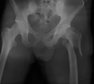 صورة توضيحية لـ كسر عظم الفخذ بين المدورين غير المستقر: دليلك الشامل للتشخيص والعلاج والتعافي مع الأستاذ الدكتور محمد هطيف