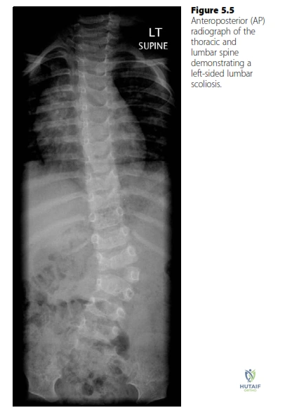 ABOS Part I Orthopaedic Review: Spondylolisthesis, Scoliosis & Spinal Deformity Management | Part 22224