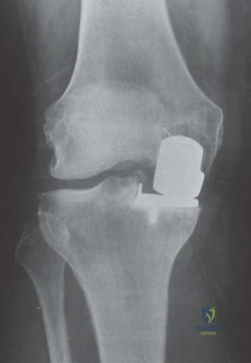 ABOS Part I & AAOS OITE Orthopaedic Surgery Exam Review: Knee Osteoarthritis & Hallux Rigidus | Part 21606