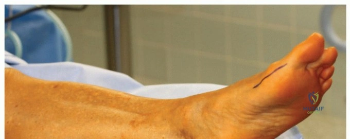 ABOS Part I Orthopaedic Board Review: PJI & Arthroplasty Revision Cases | Part 21603