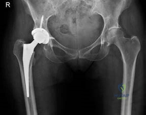 Illustration 3 for Structured Hip Oral Examination: Master This Complex Case