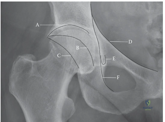 ABOS Part I Orthopedic Surgery Review: Proximal Humerus, Hip Arthroplasty & Acetabular Fractures | Part 21544