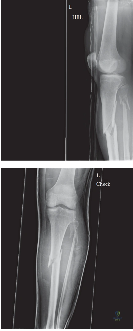 Illustration of trauma case tibial - Dr. Mohammed Hutaif