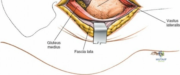 ABOS Part I & OITE Orthopaedic Trauma & Lower Extremity Review Questions | Part 21571