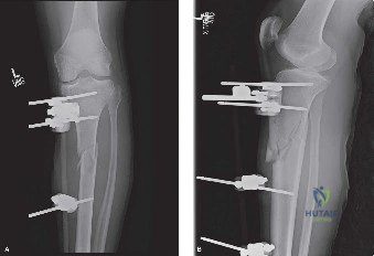 Advanced ABOS Part I Orthopaedic Review: Tibia & Osteoporotic Fracture Fixation | Part 21584