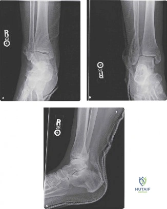 Comprehensive ABOS Part I & OITE Orthopedic Review: Olecranon, Syndesmotic, Femoral Neck Fractures | Part 21545