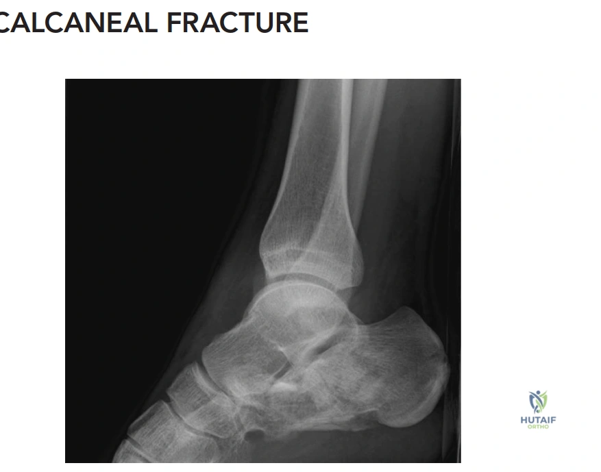 ABOS Part I Orthopedic Review: Ankle & Calcaneal Fractures, Surgical Management & Rehabilitation | Part 22208