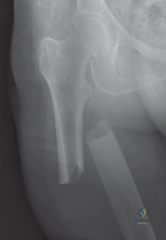 Orthopaedic Board Review: Pelvic Ring & Periprosthetic Femoral Fractures Management | Part 21570