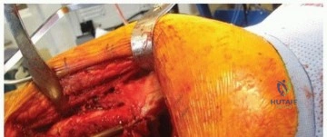Comprehensive Orthopedic Surgery Board Review: Biomechanics, Fractures, Shoulder & Wrist Instability | Part 21546