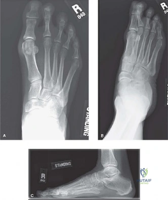 Illustration of second metatarsophalangeal joint - Dr. Mohammed Hutaif