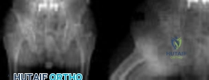 ABOS Part I & AAOS OITE Orthopaedic Review: Blount Disease & Achilles Rupture MCQs for Board Prep | Part 21566