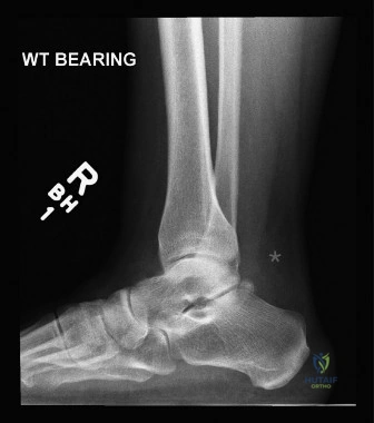 Achilles Tendon Rupture: Comprehensive Guide to Epidemiology, Anatomy, Biomechanics, and the Critical Watershed Zone