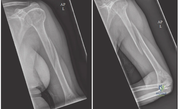 Illustration of midshaft humerus fracture - Dr. Mohammed Hutaif
