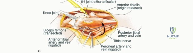 ABOS Part I & OITE Orthopaedic Review: Fibrous Dysplasia, Charcot, Rotator Cuff Tears & Shoulder Arthroplasty | Part 21549