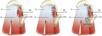 تمزق الكفة المدورة على شكل حرف L وإصلاحه باستخدام التقارب الهامشي. SS: العضلة فوق الشوكة، IS: العضلة تحت الشوكة، RI: الفاصل المدور، CHL: الرباط الغرابي العضدي، Sub: العضلة تحت الكتف.