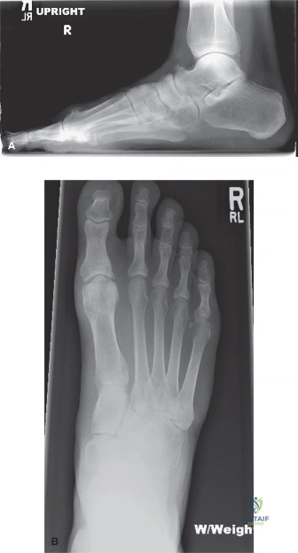 Hallux Rigidus: Pathophysiology, Surgical Anatomy & Biomechanics Guide