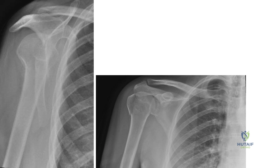 Illustration of greater tuberosity fracture - Dr. Mohammed Hutaif