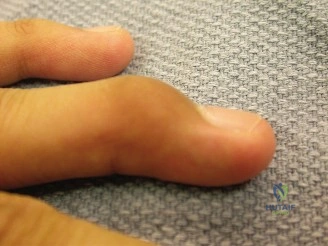 Orthopedic Surgery Board Review: Shoulder Instability, Mallet Finger, Thumb UCL, Bennett Fracture | Diagnosis & Management | Part 21554