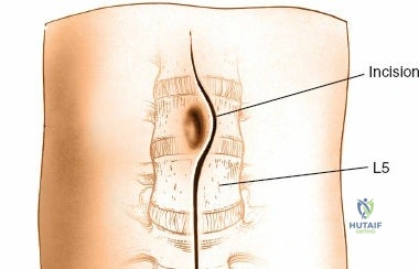 ABOS Part I Orthopaedic Surgery Board Exam Review: Lower Limb Deformity & Paley's Principles MCQs | Part 22028