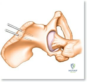 ABOS Part I Orthopedic Surgery Board Review: Paley's Principles & Deformity Correction MCQs | Part 22026