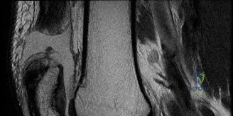 صورة توضيحية لـ تمزق الرباط الصليبي الأمامي وإصابات الركبة المعقدة: دليل شامل من الأستاذ الدكتور محمد هطيف صنعاء