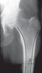 Comprehensive ABOS Part I Orthopaedic Surgery Exam Review: Perioperative, Trauma & Richter Hernia MCQs | Part 21560