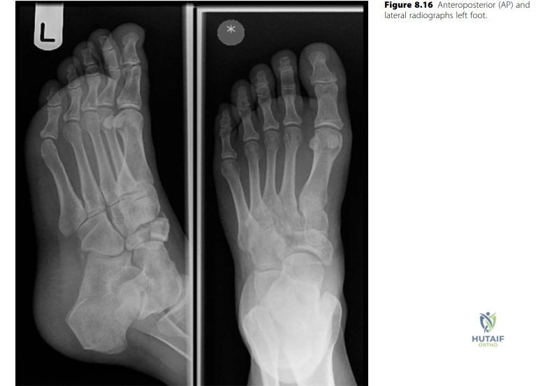 Illustration of body of navicular - Dr. Mohammed Hutaif