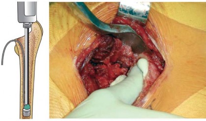 توضيح طبي: استبدال مفصل الورك الكلي بتقنية الإسمنت للفخذ: دليلك الشامل لنتائج تدوم طويلاً مع الأستاذ الدكتور محمد هطيف في صنعاء