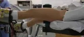 كسور عظم الفخذ: دليل المريض الشامل لعلاج الشروخ تحت العضلات واستعادة الحركة