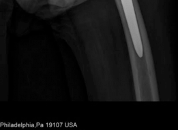 Illustration 12 for Acetabular Revision: Solving Challenges Post Two-Stage Arthroplasty