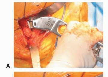 صورة طبية: نصف مفصل الورك: دليلك الشامل لدواعي الاستخدام والأنواع في صنعاء