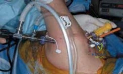 Illustration of arthroscopic dbridement and glenoidplasty - Dr. Mohammed Hutaif