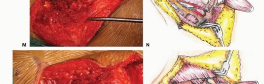 صورة طبية: جراحة أورام العجز: الحفاظ على وظائف الأمعاء والمثانة مع الأستاذ الدكتور محمد هطيف في صنعاء