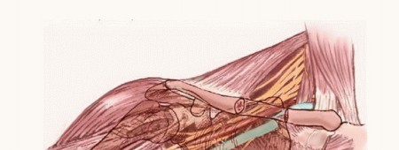 Axillary Space Exploration: Surgical Resection of Complex Tumors