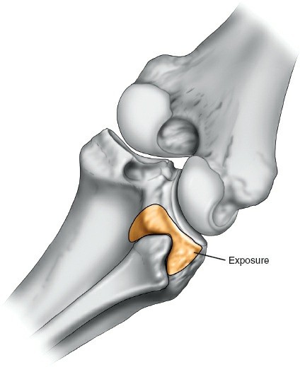 Mastering the Tibial Plateau Posterolateral Approach