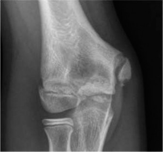 18 Pediatric Cases: Single Sport Specialization Risks Unpacked