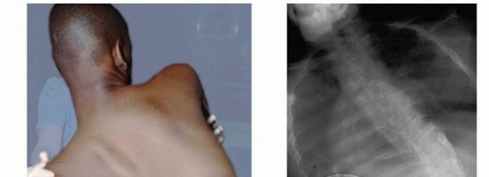 Duchenne Muscular Dystrophy: Is Spinal Fusion the Answer?