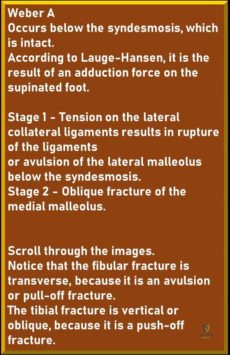 Illustration of ankle injuries weber - Dr. Mohammed Hutaif