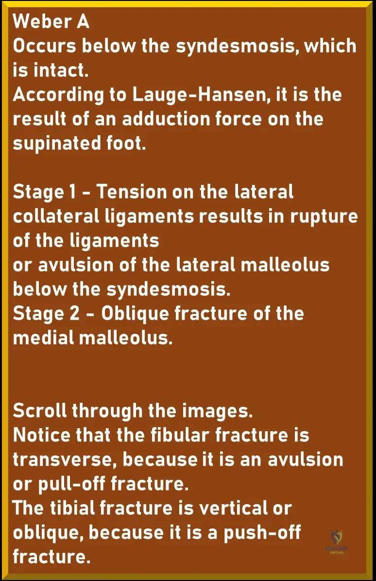Illustration of ankle injuries weber - Dr. Mohammed Hutaif