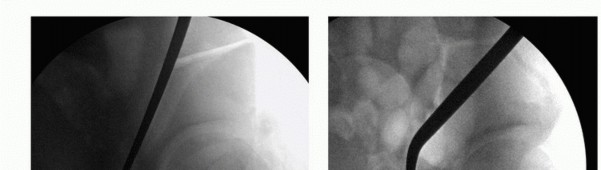 Illustration 21 for Periacetabular Osteotomy: Realigning your hip via the superior pubic ramus