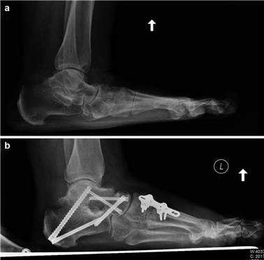 Illustration 17 for First Metatarsal Surgery: Expert Solutions for Foot & Ankle Pain