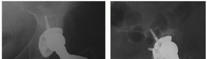 Illustration of polyethylene liner exchange - Dr. Mohammed Hutaif