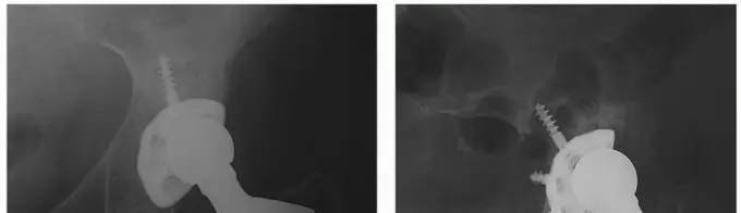 صورة توضيحية لـ هشاشة العظام حول مفصل الورك الاصطناعي تبديل بطانة البولي إيثيلين الحل الأمثل