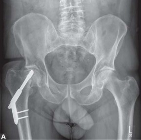 صورة توضيحية لـ جراحة استبدال مفصل الورك في كسور الفخذ القريبة: دليل شامل للمرضى مع الأستاذ الدكتور محمد هطيف